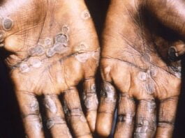 © CDC Monkeypox lesions often appear on the palms of hands.