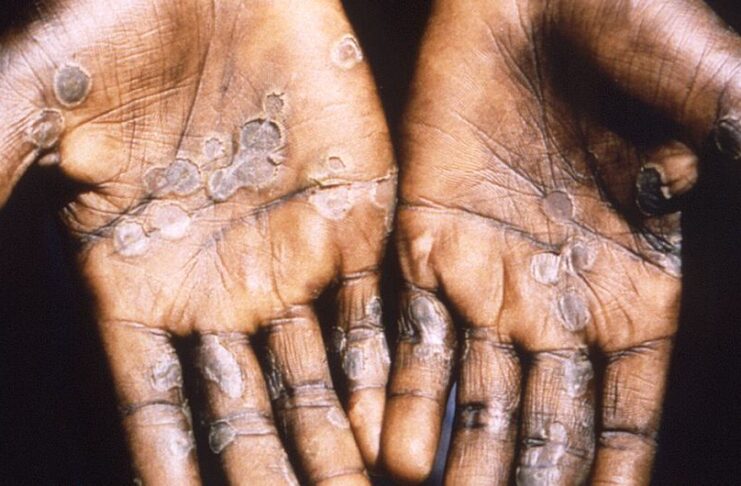 © CDC Monkeypox lesions often appear on the palms of hands.